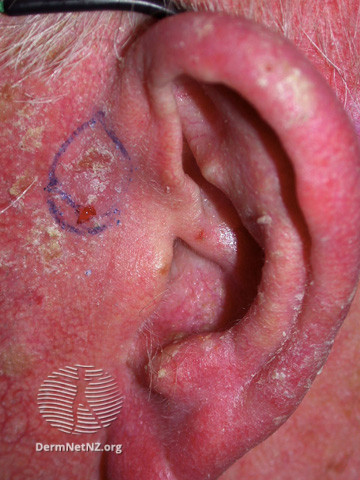 File:Basal cell carcinoma affecting the ear (DermNet NZ lesions-bcc-ear-0952).jpg