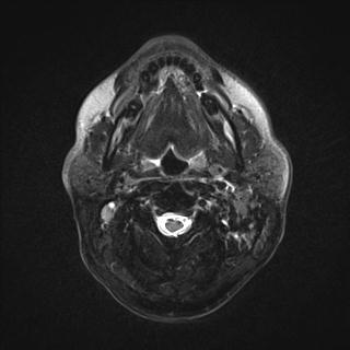 File:Base of tongue squamous cell carcinoma (Radiopaedia 31174-31884 Axial T2 fat sat 17).jpg