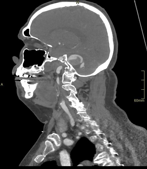 Basilar artery aneurysm (Radiopaedia 56261-62932 C 16).jpg