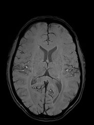 Basilar artery perforator aneurysm (Radiopaedia 82455-97733 Axial SWI 32).jpg