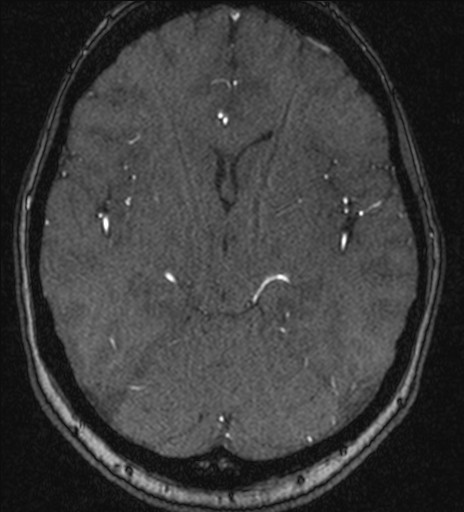 Basilar tip aneurysm (Radiopaedia 26504-26632 MRA 110).jpg
