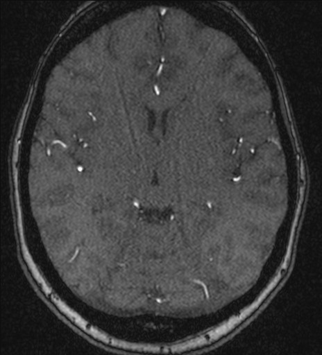 File:Basilar tip aneurysm (Radiopaedia 26504-26632 MRA 120).jpg