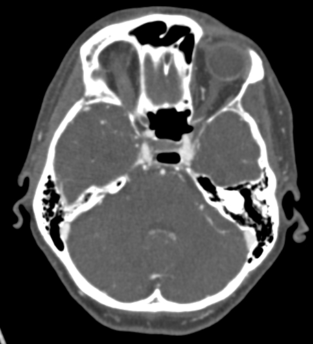 File:Basilar tip aneurysm with coiling (Radiopaedia 53912-60086 A 46).jpg