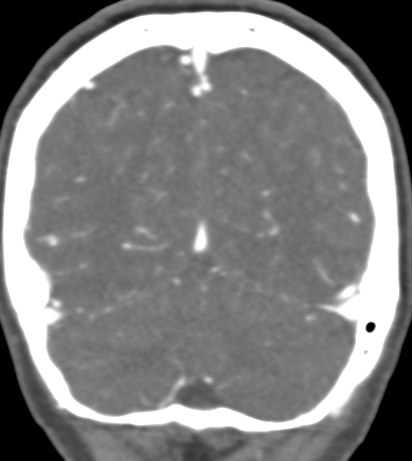 Basilar tip aneurysm with coiling (Radiopaedia 53912-60086 B 127).jpg
