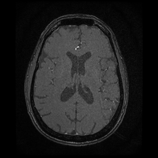 Basilar top and left middle cerebral artery aneurysm (Radiopaedia 61965-70031 Axial MRA 101).jpg
