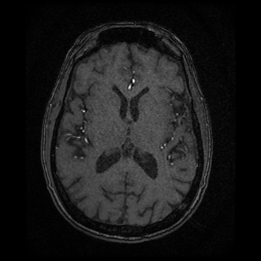 Basilar top and left middle cerebral artery aneurysm (Radiopaedia 61965-70031 Axial MRA 93).jpg