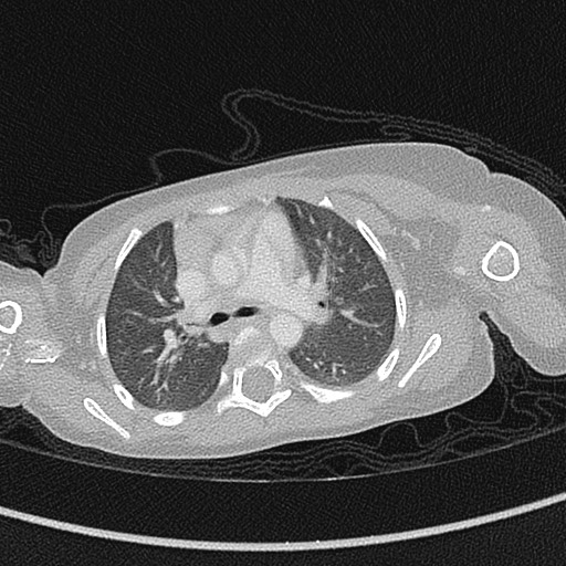 Beckwith-Wiedeman syndrome with bilateral Wilms tumors (Radiopaedia 60850-68629 Axial lung window 26).jpg