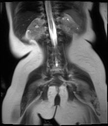 File:Beckwith-Wiedeman syndrome with bilateral Wilms tumors (Radiopaedia 60850-69233 Coronal T2 14).jpg