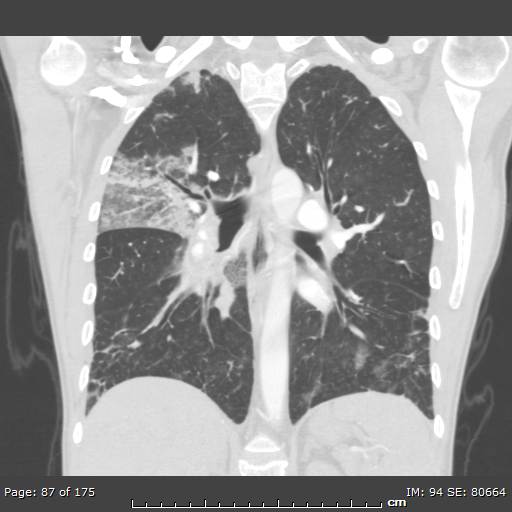 File:Behçet disease (Radiopaedia 44247-47889 Coronal lung window 25).jpg