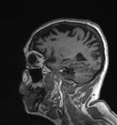 Behavioral variant frontotemporal dementia and late onset schizophrenia (Radiopaedia 52197-58083 Sagittal T1 21).png