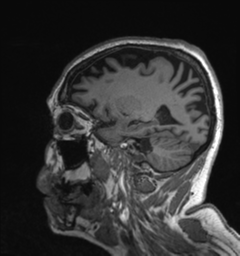 Behavioral variant frontotemporal dementia and late onset schizophrenia (Radiopaedia 52197-58083 Sagittal T1 23).png