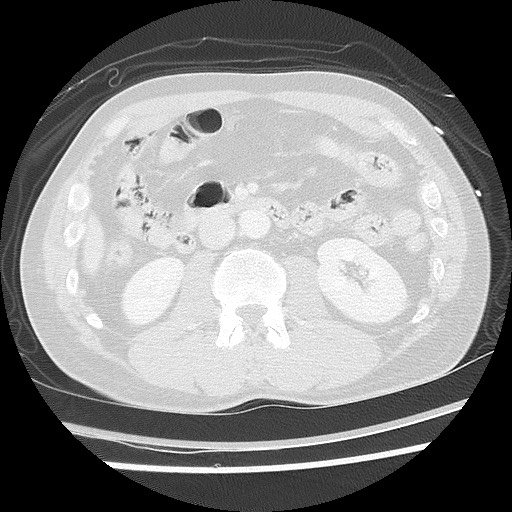 Benign post-traumatic pseudopneumoperitoneum (Radiopaedia 71199-81495 Axial lung window 86).jpg