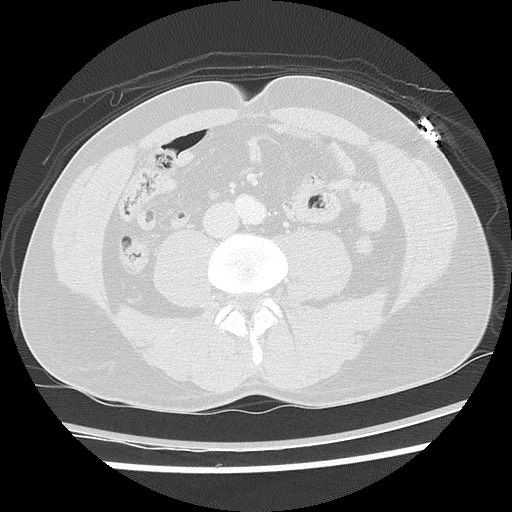 Benign post-traumatic pseudopneumoperitoneum (Radiopaedia 71199-81495 Axial lung window 99).jpg