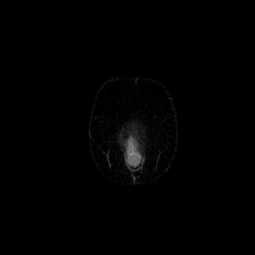 File:Benign spindle cell tumor - abdominopelvic (Radiopaedia 61300-69212 C 2).jpg