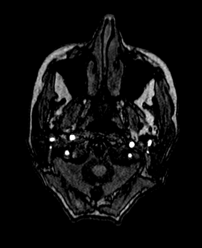 File:Berry aneurysm of the terminal internal carotid artery (Radiopaedia 88286-104918 Axial TOF 24).jpg