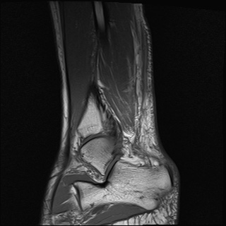 File:Bilateral Achilles tendon complete tear (Radiopaedia 81344-95051 Sagittal T1 27).jpg