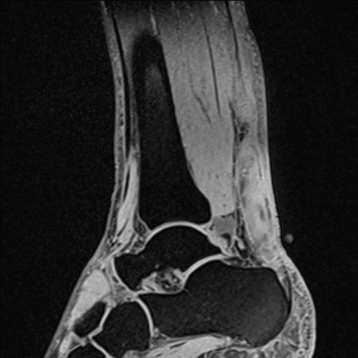 Bilateral Achilles tendon complete tear (Radiopaedia 81344-95051 Sagittal WE - Right 51).jpg