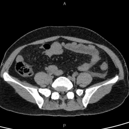 Bilateral adrenal gland hyperenhancement in pancreatitis (Radiopaedia 86642-102753 Axial non-contrast 80).jpg
