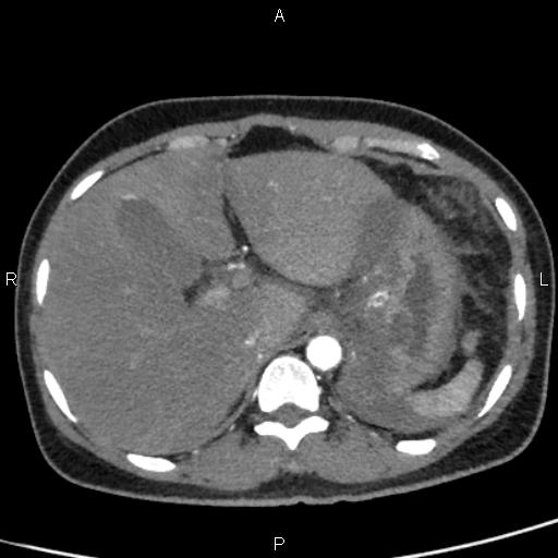 Bilateral adrenal gland hyperenhancement in pancreatitis (Radiopaedia 86642-102753 B 22).jpg