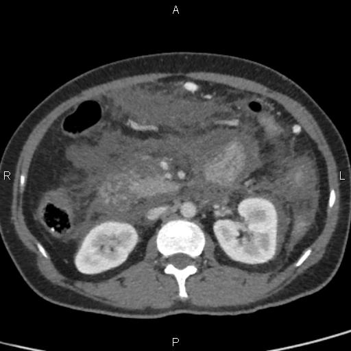 File:Bilateral adrenal gland hyperenhancement in pancreatitis (Radiopaedia 86642-102753 E 47).jpg