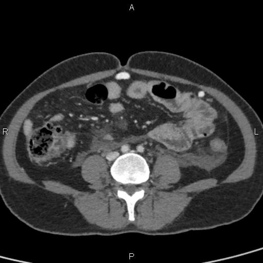 Bilateral adrenal gland hyperenhancement in pancreatitis (Radiopaedia 86642-102753 E 72).jpg