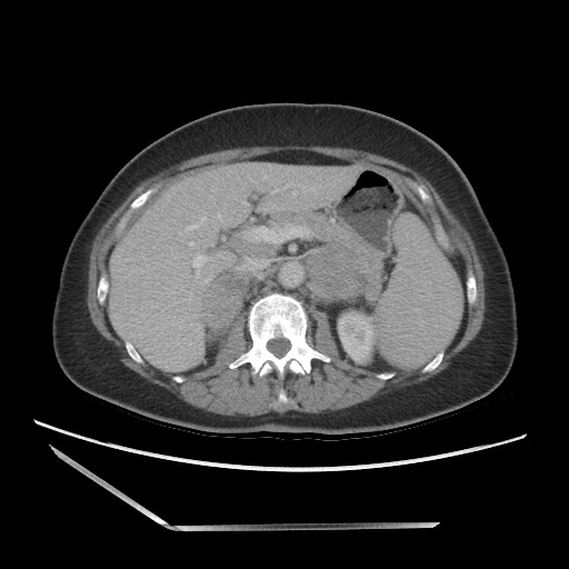 Bilateral adrenal granulocytic sarcomas (chloromas) (Radiopaedia 78375-91007 A 41).jpg