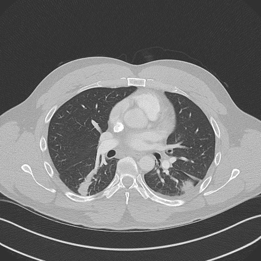 Bilateral atelectasis (Radiopaedia 48666-53675 Axial lung window 56).jpg