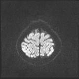 File:Bilateral basal ganglia and thalamic T1 hyperintensities (Radiopaedia 19764-19802 Axial DWI 37).jpg