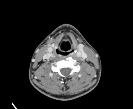 Bilateral carotid body tumors (Radiopaedia 61841-69870 Axial Post contrast 64).jpg