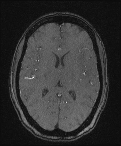 Bilateral carotid body tumors and right glomus jugulare tumor (Radiopaedia 20024-20060 Axial MRA 104).jpg