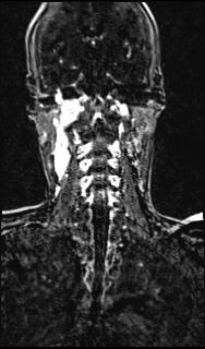 Bilateral carotid body tumors and right glomus jugulare tumor (Radiopaedia 20024-20060 MRA 114).jpg