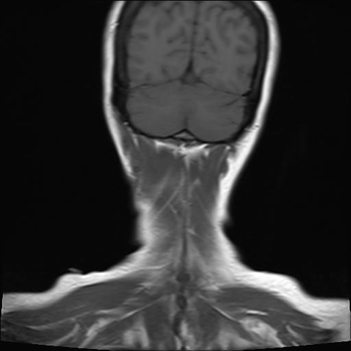 File:Bilateral carotid body tumors and right jugular paraganglioma (Radiopaedia 20024-20060 Coronal 24).jpg