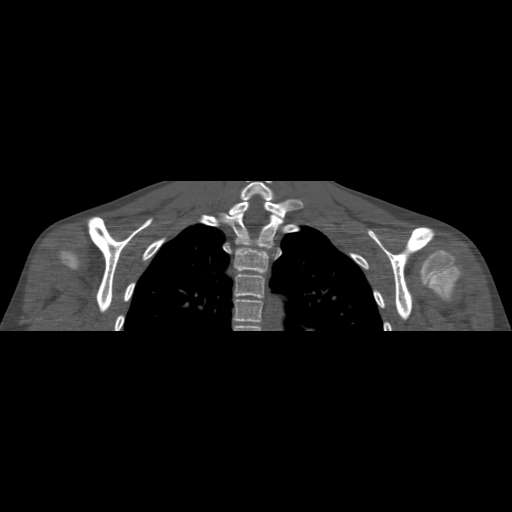 File:Bilateral chronic posterior shoulder dislocation (Radiopaedia 39213-41452 Coronal bone window 39).jpg