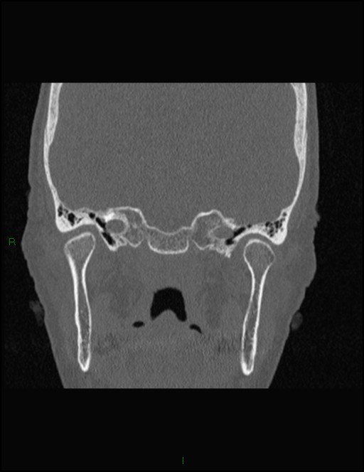 Bilateral frontal mucoceles (Radiopaedia 82352-96454 Coronal 282).jpg