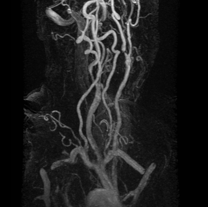 File:Bilateral internal carotid artery stenoses (Radiopaedia 14282).jpg