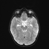 File:Bilateral mesial temporal polymicrogyria (Radiopaedia 76456-88181 Axial DWI 10).jpg
