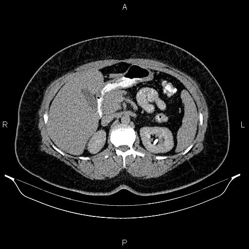 File:Bilateral ovarian dermoid cysts (Radiopaedia 85785-101603 Axial C+ delayed 21).jpg