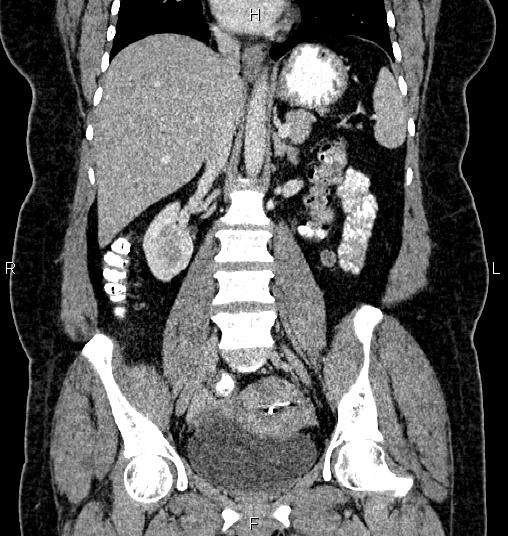 Bilateral ovarian dermoid cysts (Radiopaedia 85785-101603 C 31).jpg