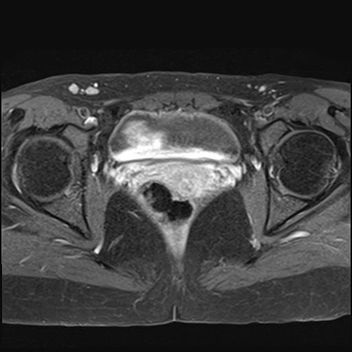 File:Bilateral ovarian endometriomas (Radiopaedia 87085-103347 Axial T1 C+ fat sat 16).jpg