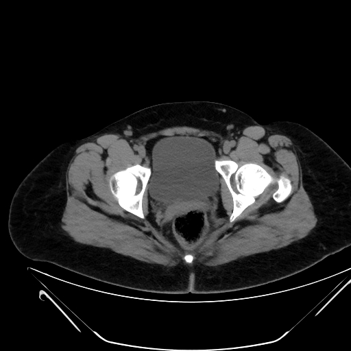 Bilateral ovarian mature cystic teratomas (Radiopaedia 79373-92457 Axial non-contrast 83).jpg