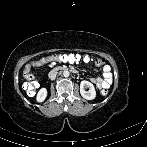 Bilateral ovarian serous cystadenocarcinoma (Radiopaedia 86062-101989 B 45).jpg