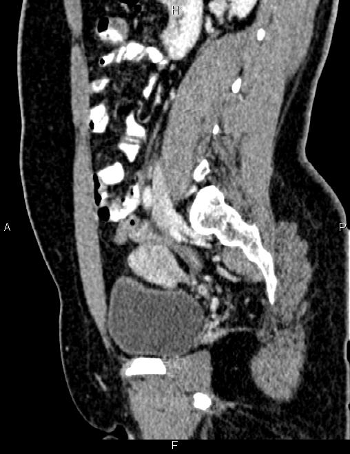 Bilateral ovarian teratoma (Radiopaedia 83131-97503 D 52).jpg