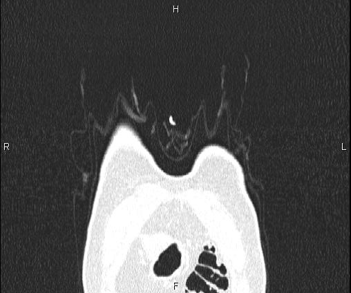 Bilateral pulmonary AVM (Radiopaedia 83134-97505 Coronal lung window 7).jpg