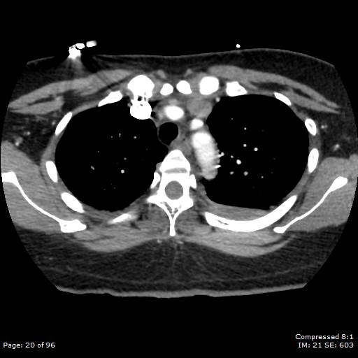 Bilateral pulmonary emboli with Hampton hump sign (Radiopaedia 54070-60246 Axial C+ CTPA 17).jpg