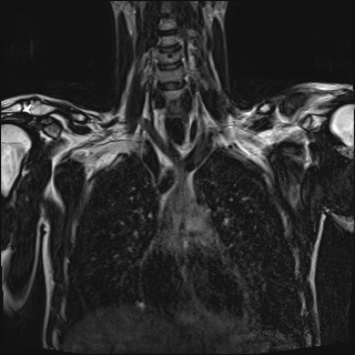 Bilateral spinoglenoid notch ganglion cysts (Radiopaedia 29577-30082 Coronal T2 45).jpg