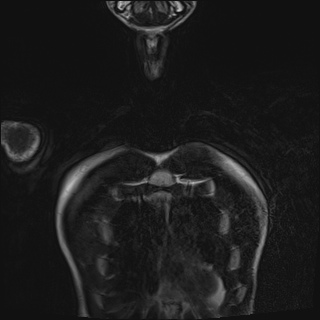 Bilateral spinoglenoid notch ganglion cysts (Radiopaedia 29577-30082 Coronal T2 7).jpg