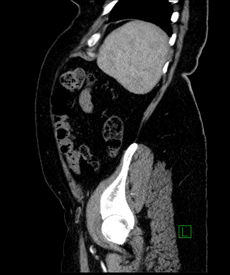 Bilateral sporadic synchronous clear cell renal cell carcinoma (Radiopaedia 85035-100575 E 29).jpg