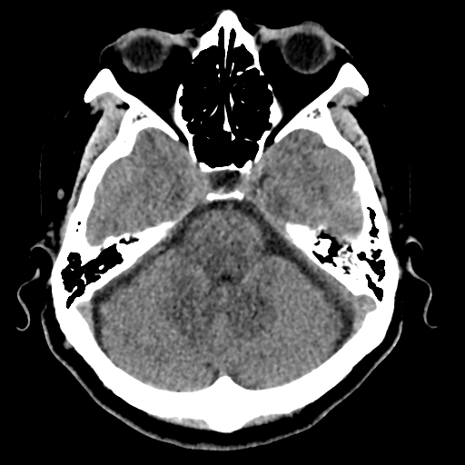 Bilateral subacute subdural hematoma (Radiopaedia 69240-79018 Axial non-contrast 14).jpg