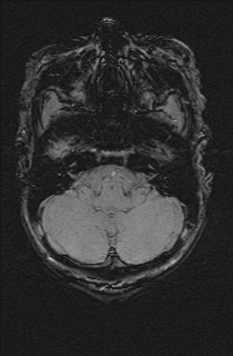Bilateral subdural hemorrhage and parietal skull fracture (Radiopaedia 26058-26190 Axial SWI 12).png