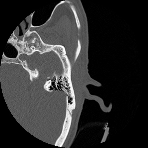 Bilateral temporal bone fractures (Radiopaedia 29482-29970 D 99).jpg